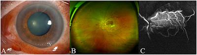 Visual Loss Caused by Central Retinal Artery Occlusion After Bee Sting: A Case Report